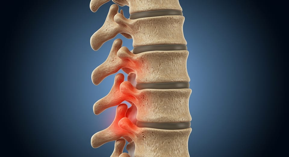 Espondiloartrose: O Que É, Causas, Sintomas e Tratamento Completo